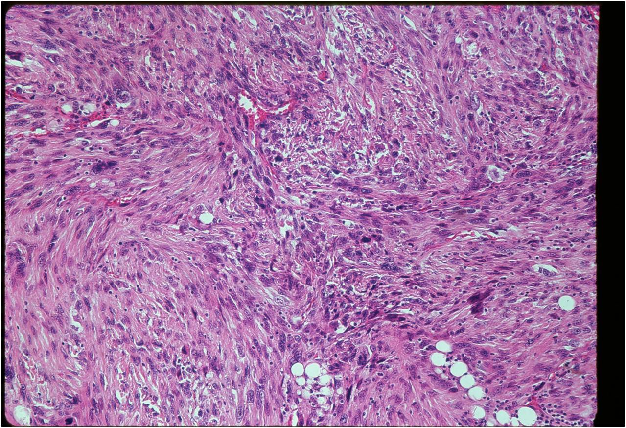 Dedifferentiated Chondrosarcoma: High PowerView of Dedifferentiated High Grade Pleomorphic Spindle Cell Component Malignant Fibrous Histiocytoma with Storiform Pattern