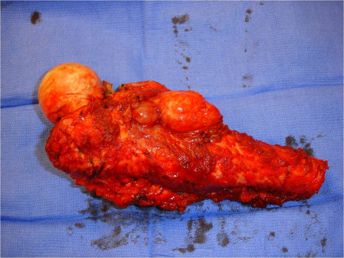 Specimen Dedifferentiated Chondrosarcoma of Proximal Femur