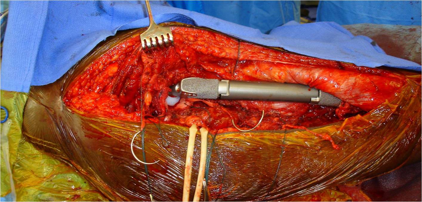 Limb Sparing Surgery for Dedifferentiated Chondrosarcoma of Proximal Femur prosthetic Reconstruction with Proximal Femur Tumor Prosthesis