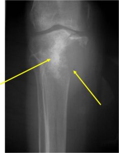 (Left Arrow)Low Grade Cartilaginous Area Heavily Calcified
(Right Arrow)Aggressive Lytic Area (Dedifferentiated Sarcomatous Component) Cortical Destruction Soft Tissue Mass without Calcification