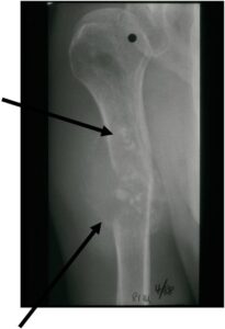 Low Grade Cartilage Component Stippled Calcifications Aggressive Dedifferentiated Sarcomatour Component Lysis, Cortical Destruction Soft Tissue Mass without Calcification