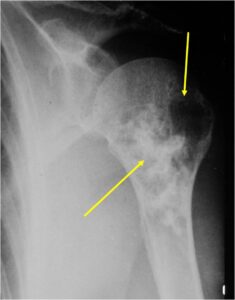 Lytic, Dedifferentiated Component Low Grade Cartilage Component Heavily Calcified
