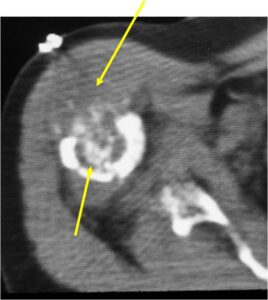 Soft Tissue Extension on CT Ring and Arc Calcifications