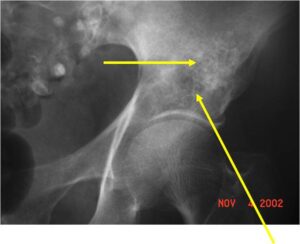 Plain Xray: Dedifferentiated Chondrosarcoma of Acetabulum Ring and Arc Calcification