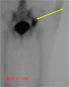 Bone Scan: Increased Uptake in Dedifferentiated Chondrosarcoma of Left Acetabulum
