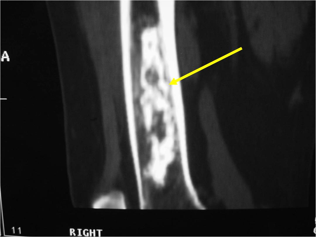 CT Scan: Enchondroma of Femur. Minimal Endosteal Scalloping is Acceptable