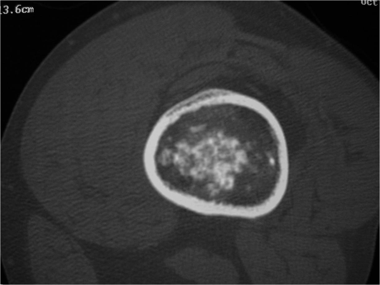CT Scan: Enchondroma of Femur: Ring and Arc-Calcifications. Small Rings/Circles of Calcification. No Endosteal Erosion/Scalloping. Cortex is Intact