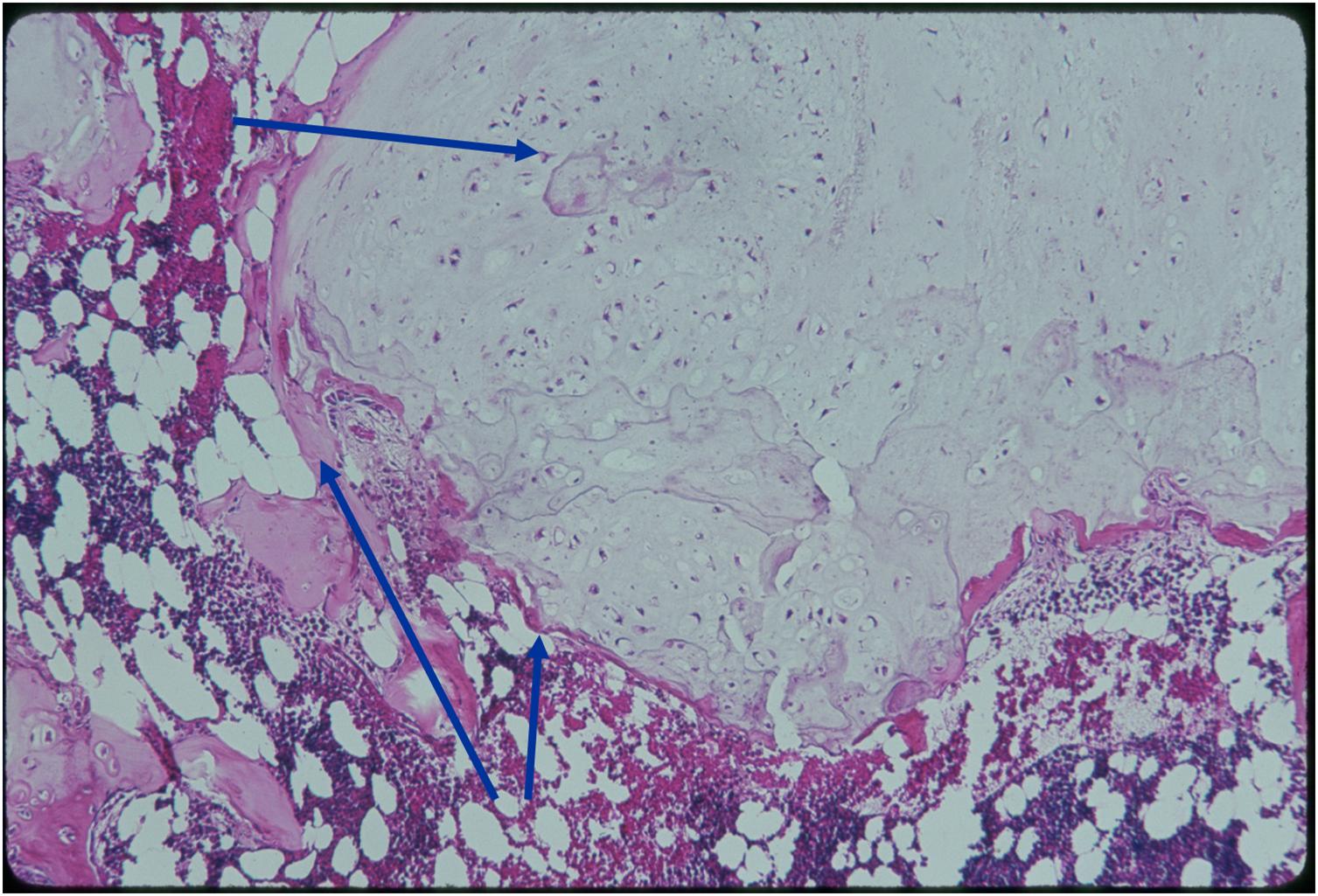 Microscopic Pathology: Enchondroma (Top Arrow) Cells in Lacunai Hypocellular Lobular Growth No Pelomorphiam Matrix Ground Glass (Bottom Arrow) Enchondral Ossification around Periphery Microscopic Pathology: Enchondroma (Top Arrow) Cells in Lacunai Hypocellular Lobular Growth No Pelomorphiam Matrix Ground Glass (Bottom Arrow) Enchondral Ossification around Periphery