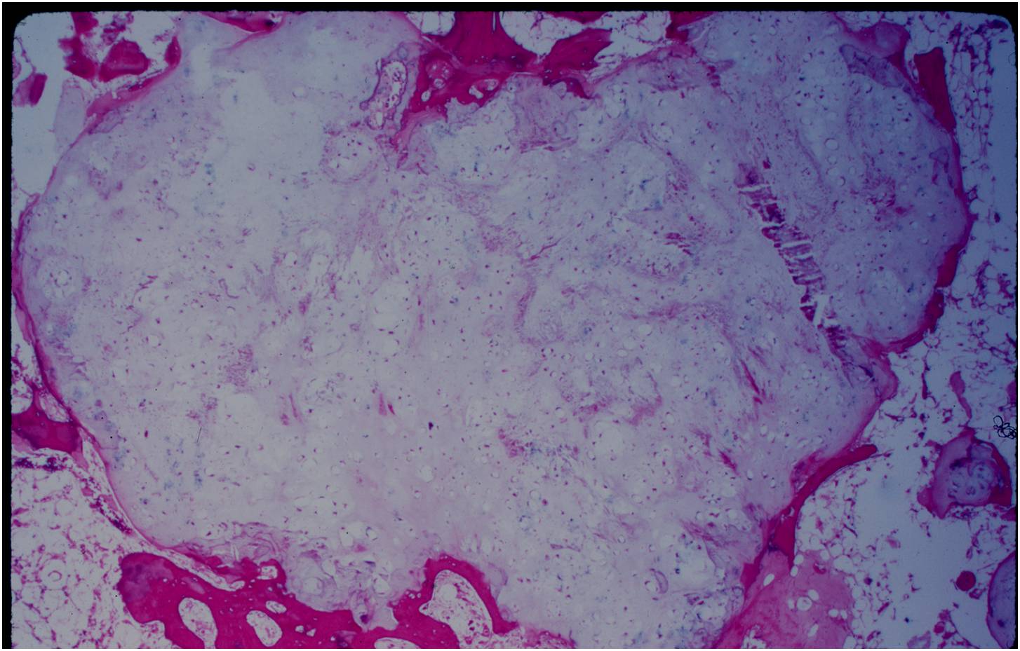 Microscopic Pathology: Enchondroma