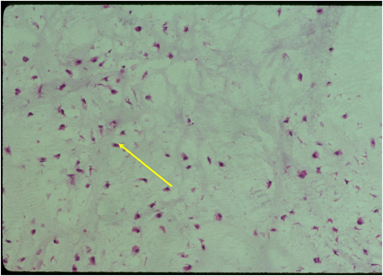 Microscopic Pathology: Enchondroma Hypocellular Cells are Bland and in Lacunae Occasional Binucleated Cells No Mitoses Binucleated Lacunae (arrow) Microscopic Pathology: Enchondroma Hypocellular Cells are Bland and in Lacunae Occasional Binucleated Cells No Mitoses Binucleated Lacunae (arrow)