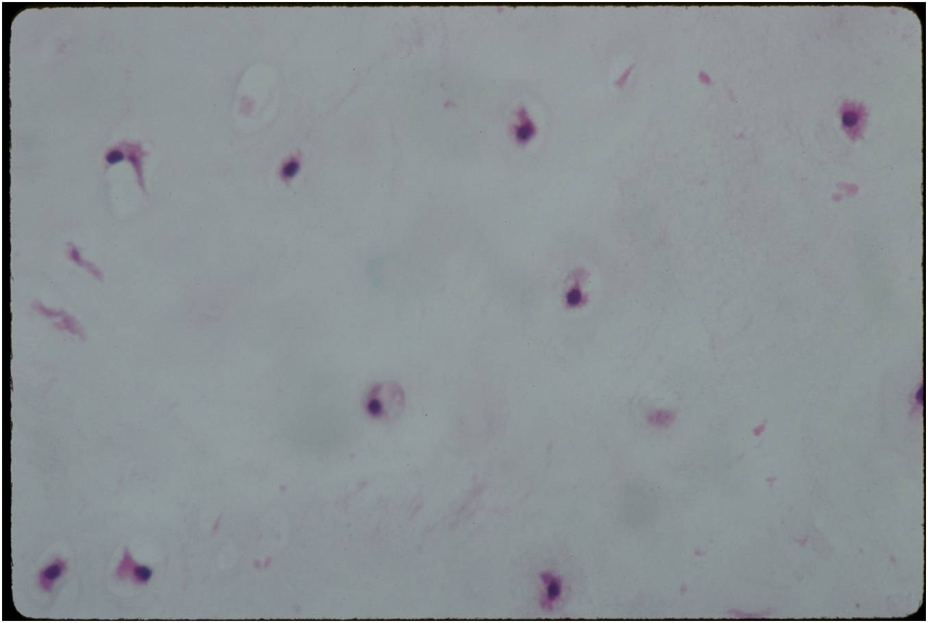 Microscopic Pathology: Enchondroma