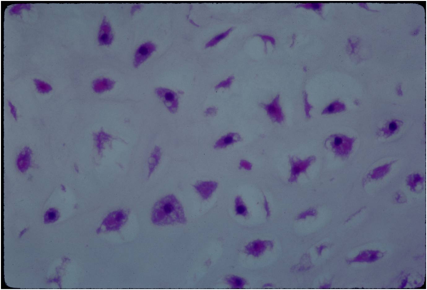 Microscopic Pathology: Enchondroma of a Digit. Slightly More Hypercellular. Occasional Binucleated Cells. No Mitoses. Minimal Pleomorphism