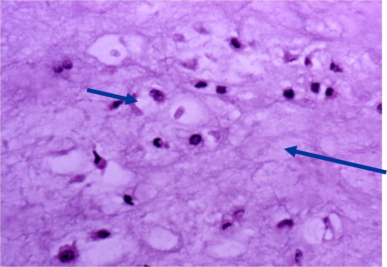 Microscopic Pathology: Enchondroma of a Digit. Occasional Areas of Myxoid Change are Acceptable. Cells in Lacunae (arrow left). Myxoid Matrix (arrow right)