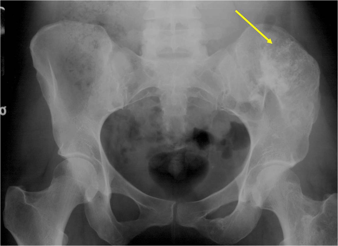 Plain X-ray: Enchondromatosis of Pelvis Maffucci's Syndrome Plain X-ray: Enchondromatosis of Pelvis Maffucci's Syndrome