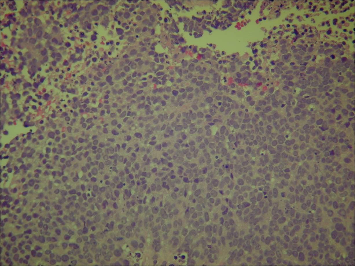 Microscopic Pathology: Ewing Sarcoma Microscopic Pathology: Ewing Sarcoma