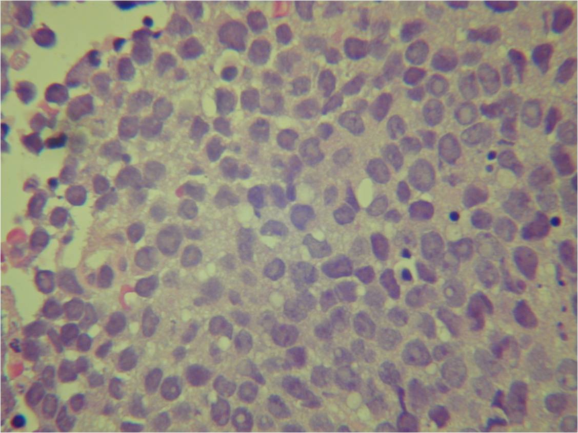 Microscopic Pathology: Ewing Sarcoma Microscopic Pathology: Ewing Sarcoma