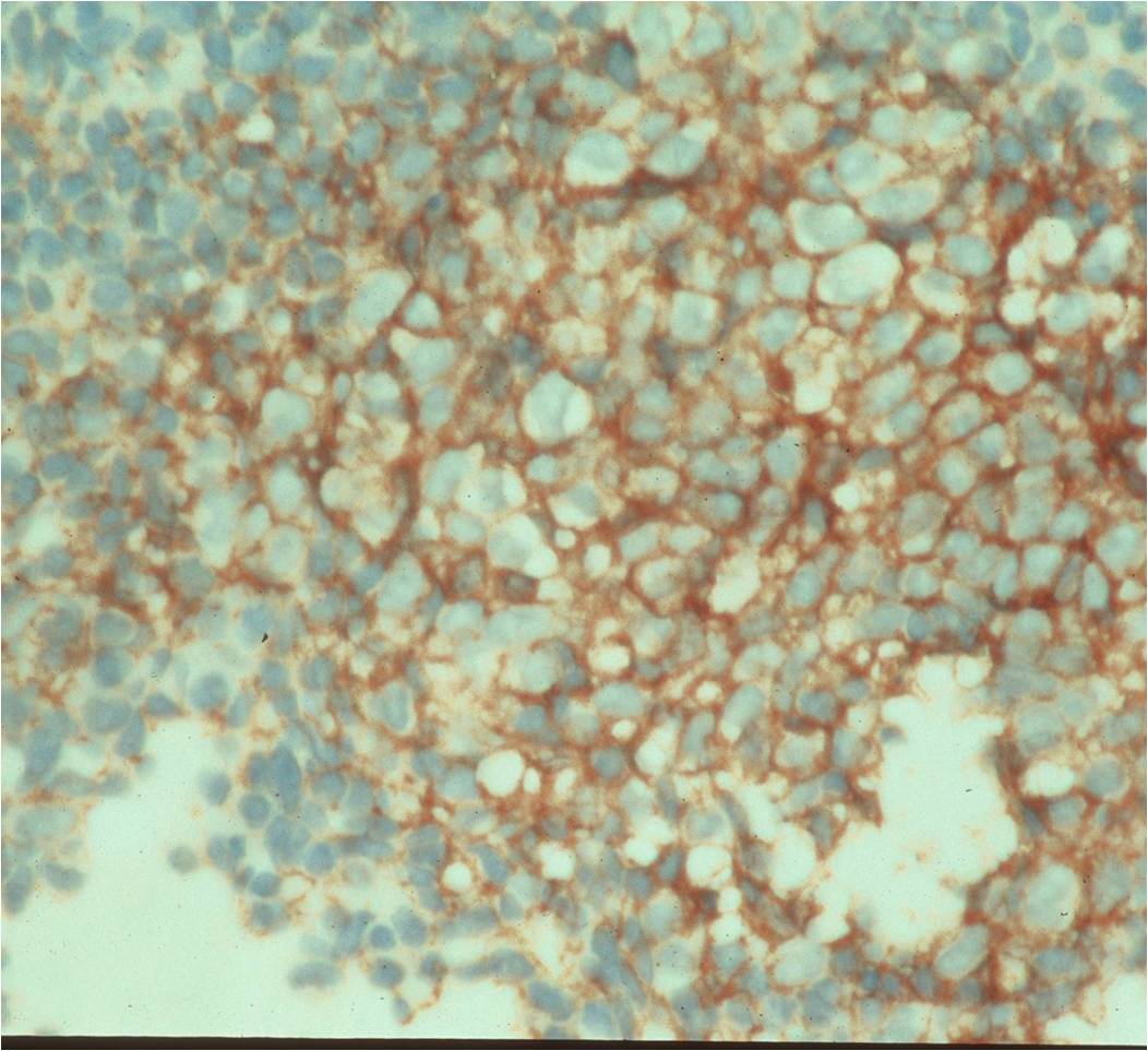 Ewing Sarcoma: CD99 Stain Positive Identifies MIC2 Overexpression Ewing Sarcoma: CD99 Stain Positive Identifies MIC2 Overexpression