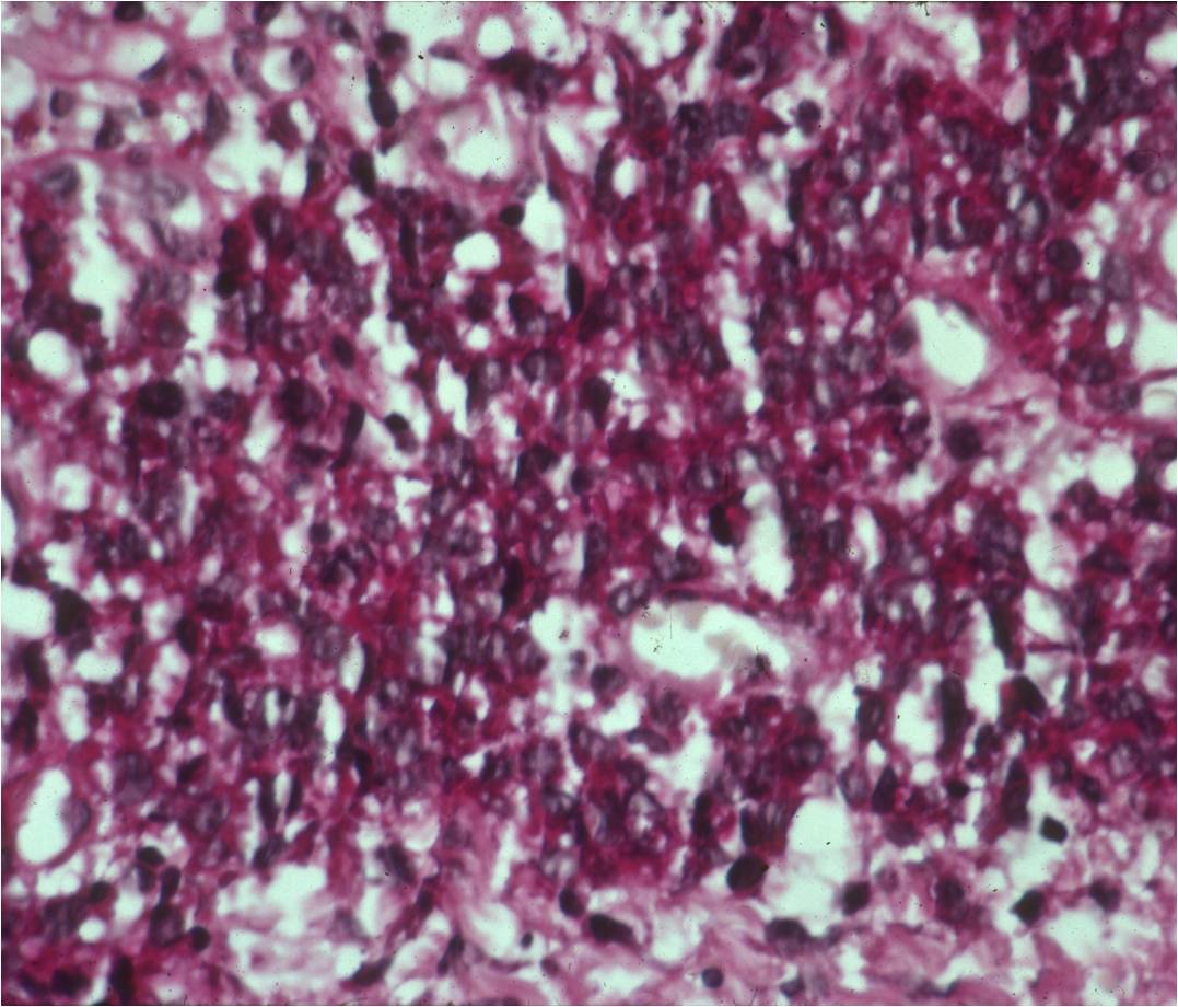 Ewing Sarcoma: PAS Positive Glycogen Positivity Ewing Sarcoma: PAS Positive Glycogen Positivity