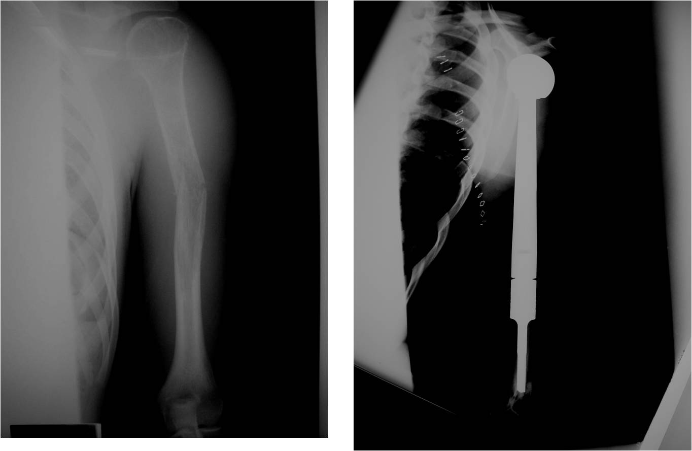 Ewing Sarcoma: Prosthetic Reconstruction of Proximal Humerus with Proximal Humerus Tumor Prosthesis Limb Sparing Surgery