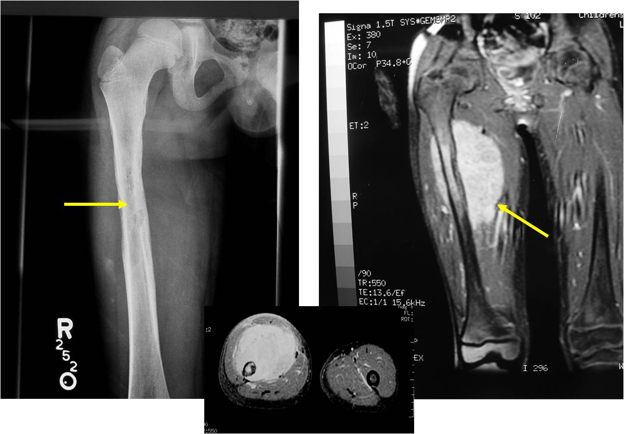 X-ray/MRI: Ewing Sarcoma of Diaphysis of Femur Tumor Barely Perceptible on X-Ray MRI Demonstrates Marrow Involvement and Large Soft Tissue Mass (Left arrow) Permeative Bone Destruction (Right arrow) Soft Tissue Mass