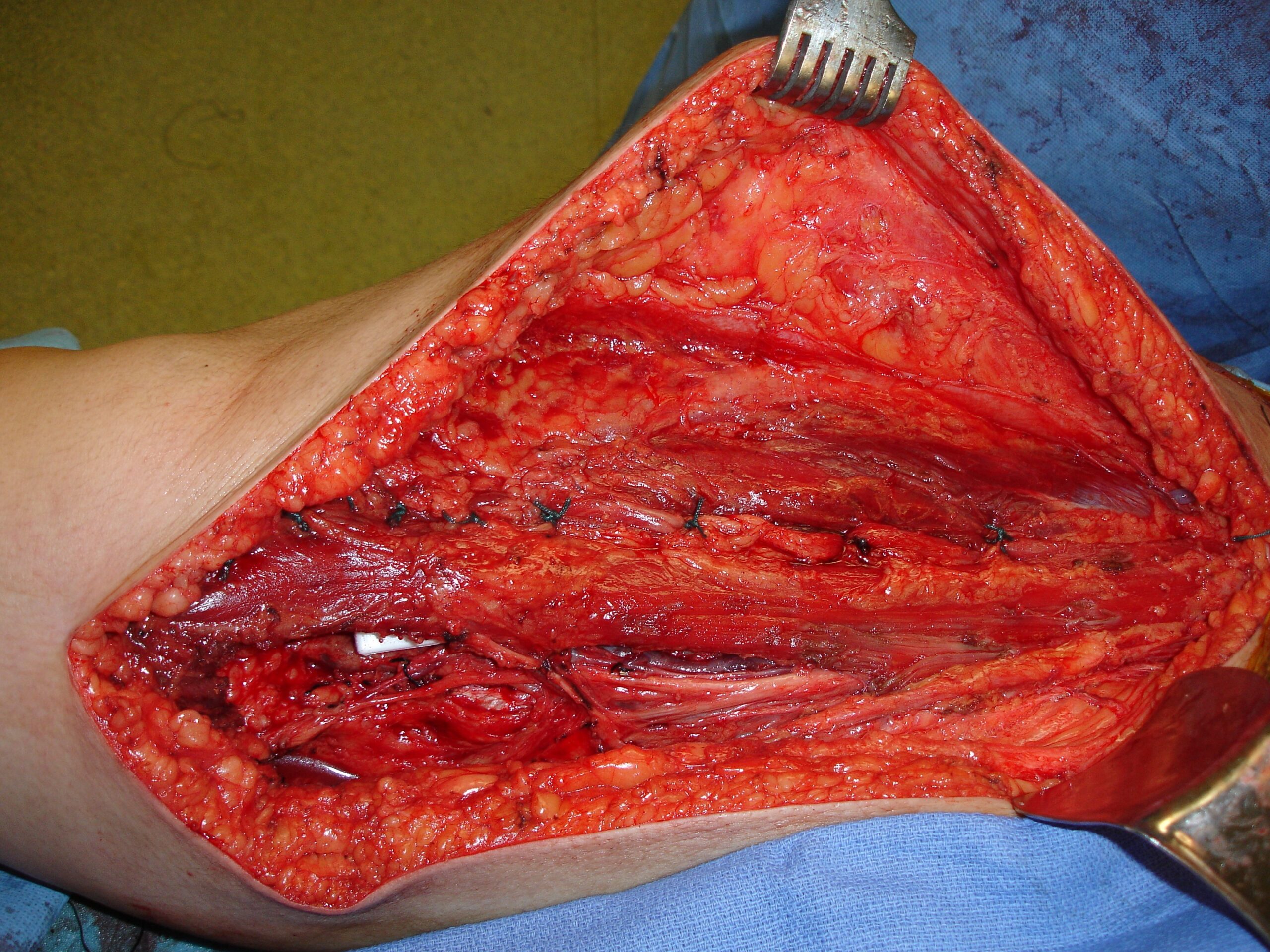 Fig. 10 Intraoperative photo shows muscle flap rotation for closure of the dead space after tumor removal. Fig. 10 Intraoperative photo shows muscle flap rotation for closure of the dead space after tumor removal.