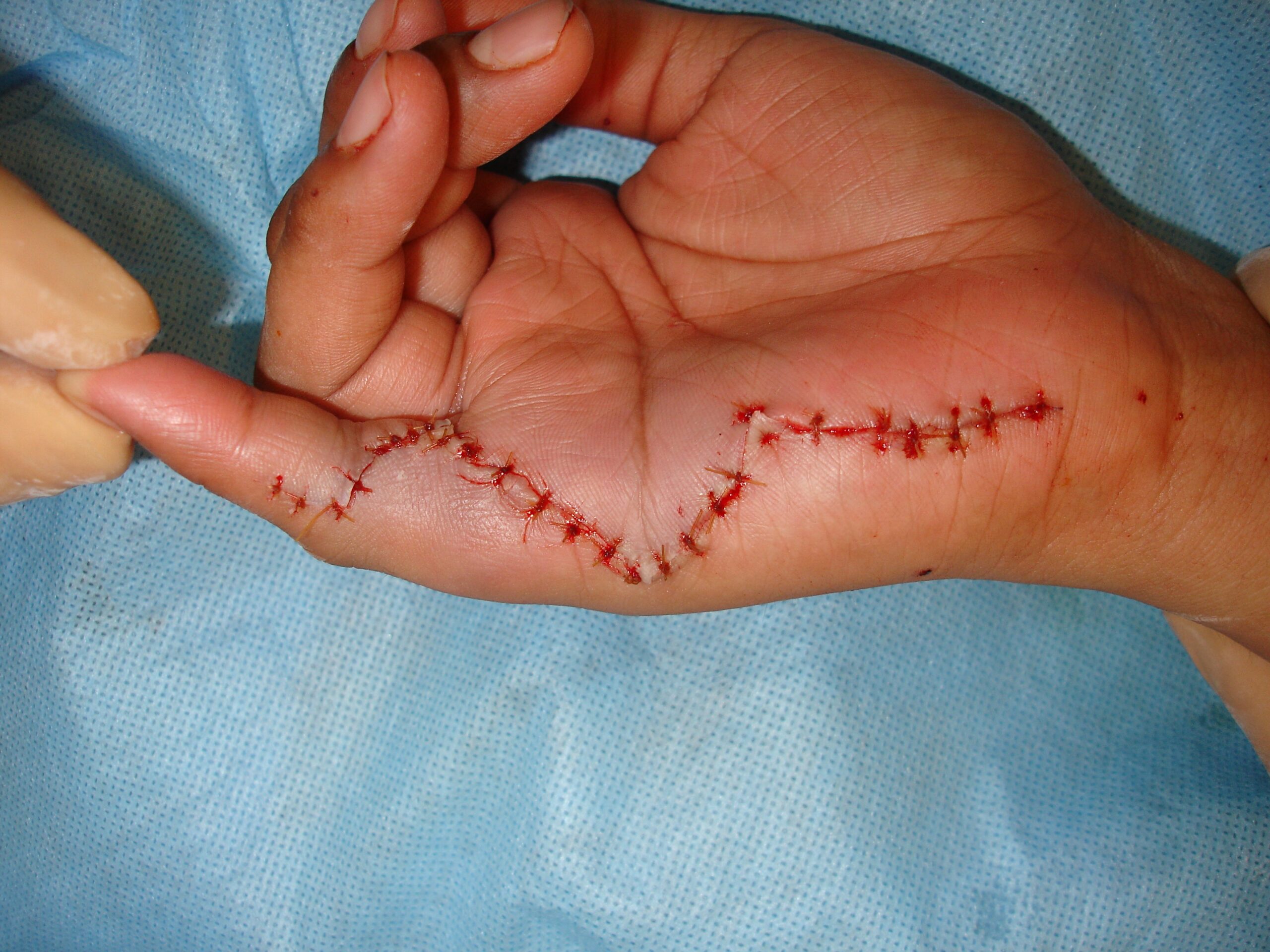 Fig. 12: Postoperative photo of the hand shows a sutured surgical incision in the hand after an extensive resection of a Giant cell tumor of the tendon sheath. Fig. 12: Postoperative photo of the hand shows a sutured surgical incision in the hand after an extensive resection of a Giant cell tumor of the tendon sheath.