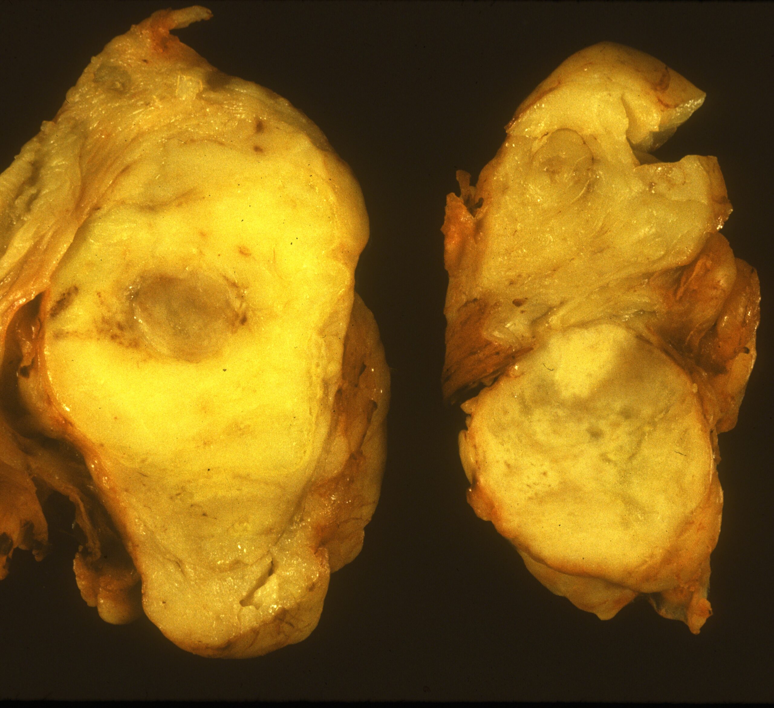 Fig. 14 Gross Pathology. A large yellow white mass is seen that resembles lipoma or a low grade liposarcoma with central fat necrosis. Gray areas correspond to non lipomatous tumor, the dedifferentiated area (DDLPS).
