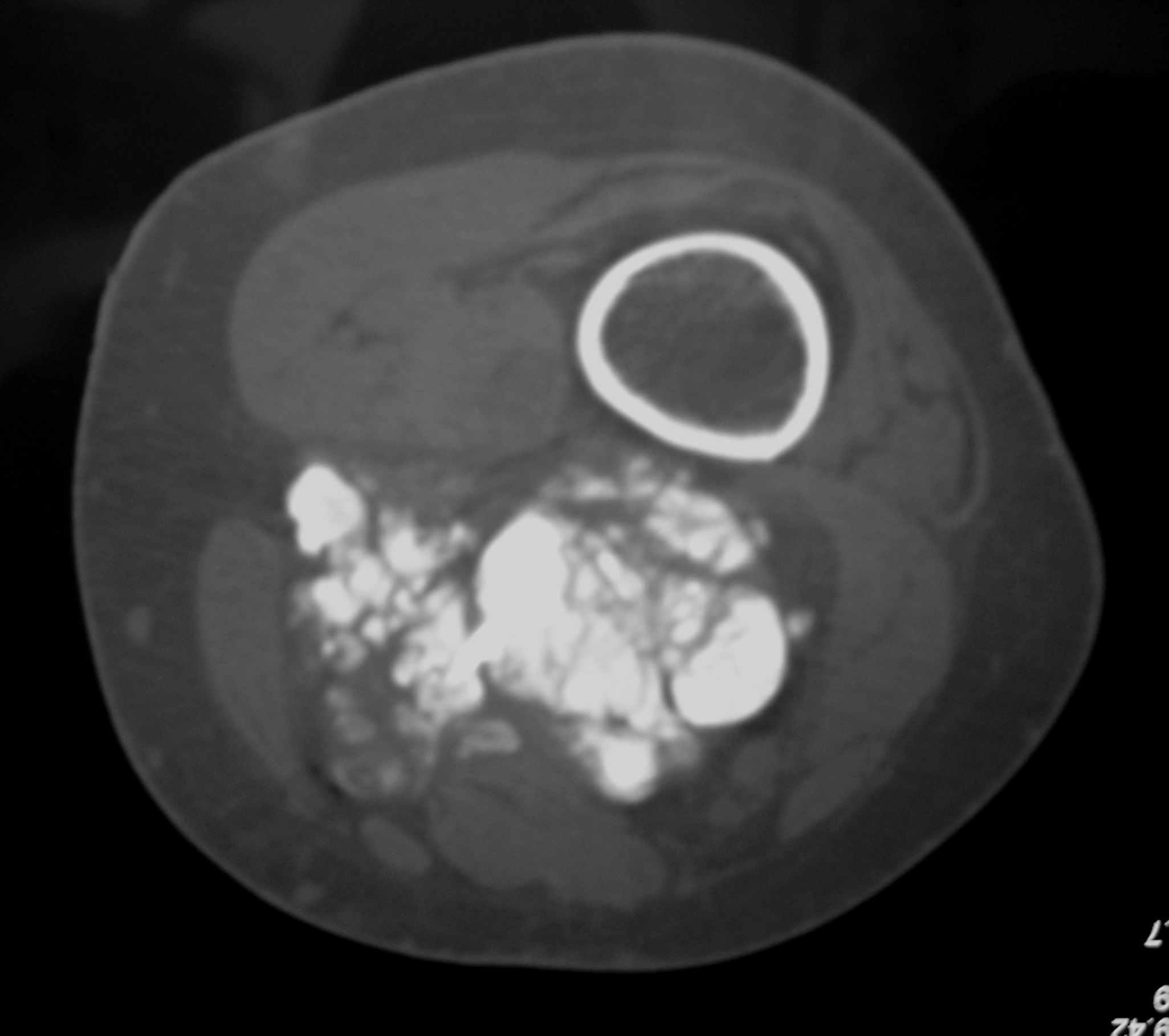 Fig. 3: CT scan image demonstrates cloud like (mineralization) of a mass in the posterior thigh not in contact with the distal femur. Fig. 3: CT scan image demonstrates cloud like (mineralization) of a mass in the posterior thigh not in contact with the distal femur.