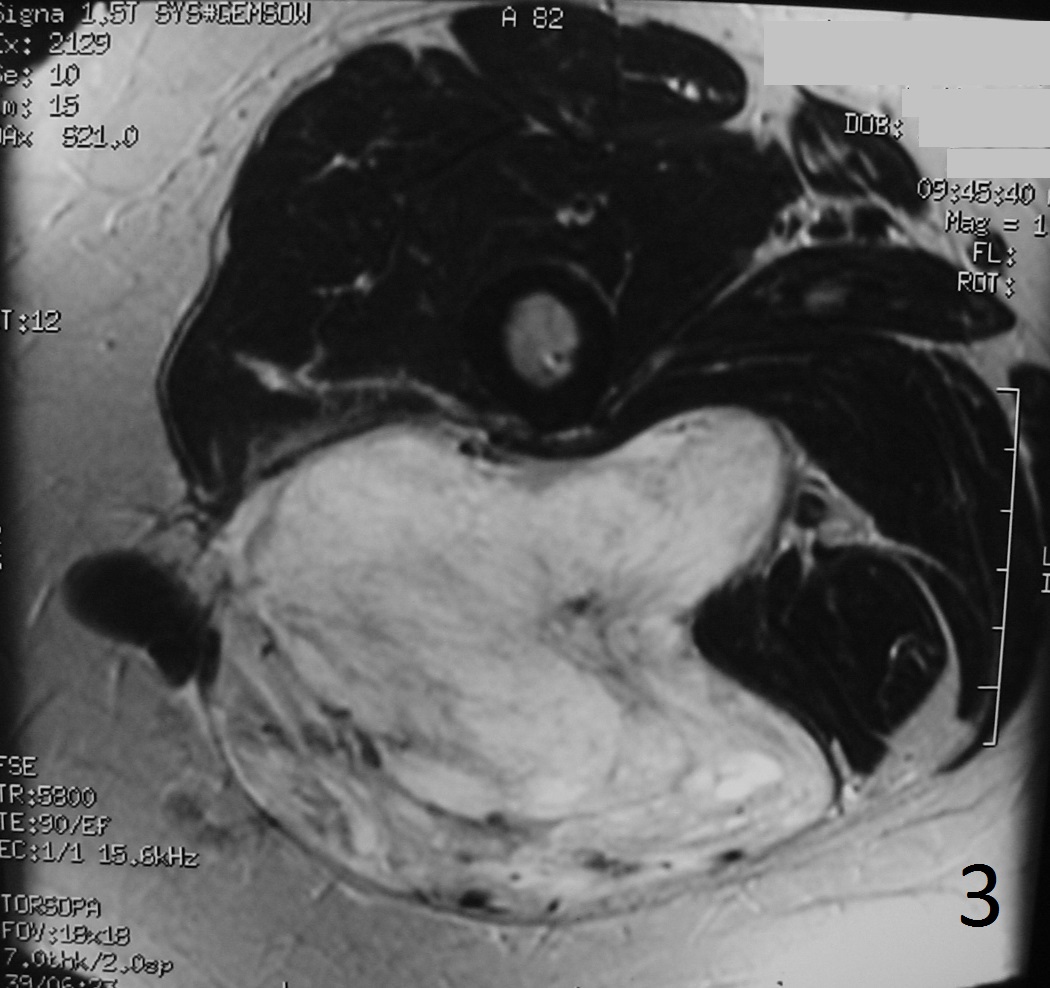 Fig. 3: Axial T2W image shows a mass with primarily high signal intensity although heterogeneous and heavily septated Fig. 3: Axial T2W image shows a mass with primarily high signal intensity although heterogeneous and heavily septated