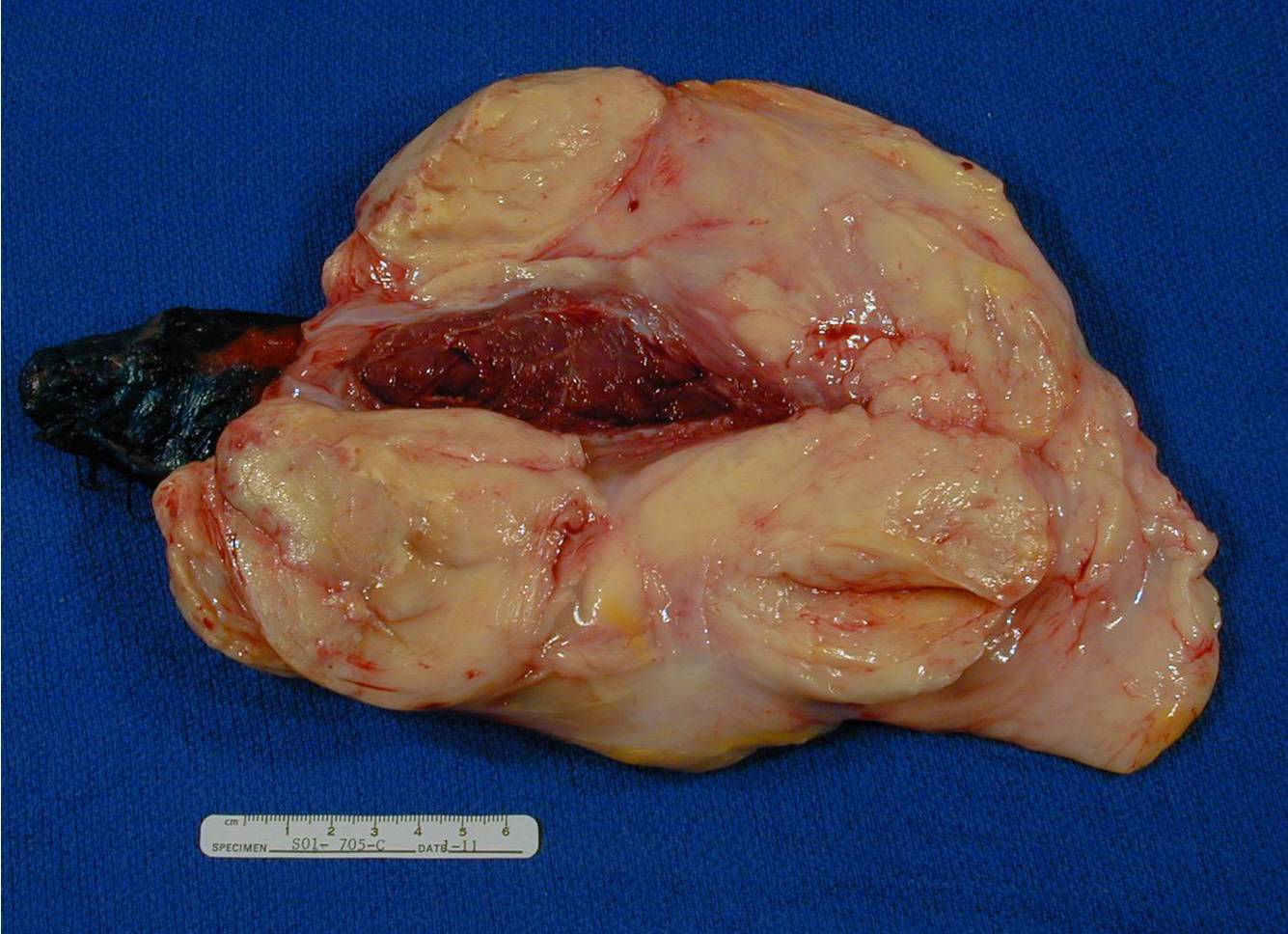 Fig. 5 Gross Pathology. Large lipomatous mass. Well circumscribed and lobulated white-yellow mass. Areas of fat necrosis are common in larger lesions. Fig. 5 Gross Pathology. Large lipomatous mass. Well circumscribed and lobulated white-yellow mass. Areas of fat necrosis are common in larger lesions.