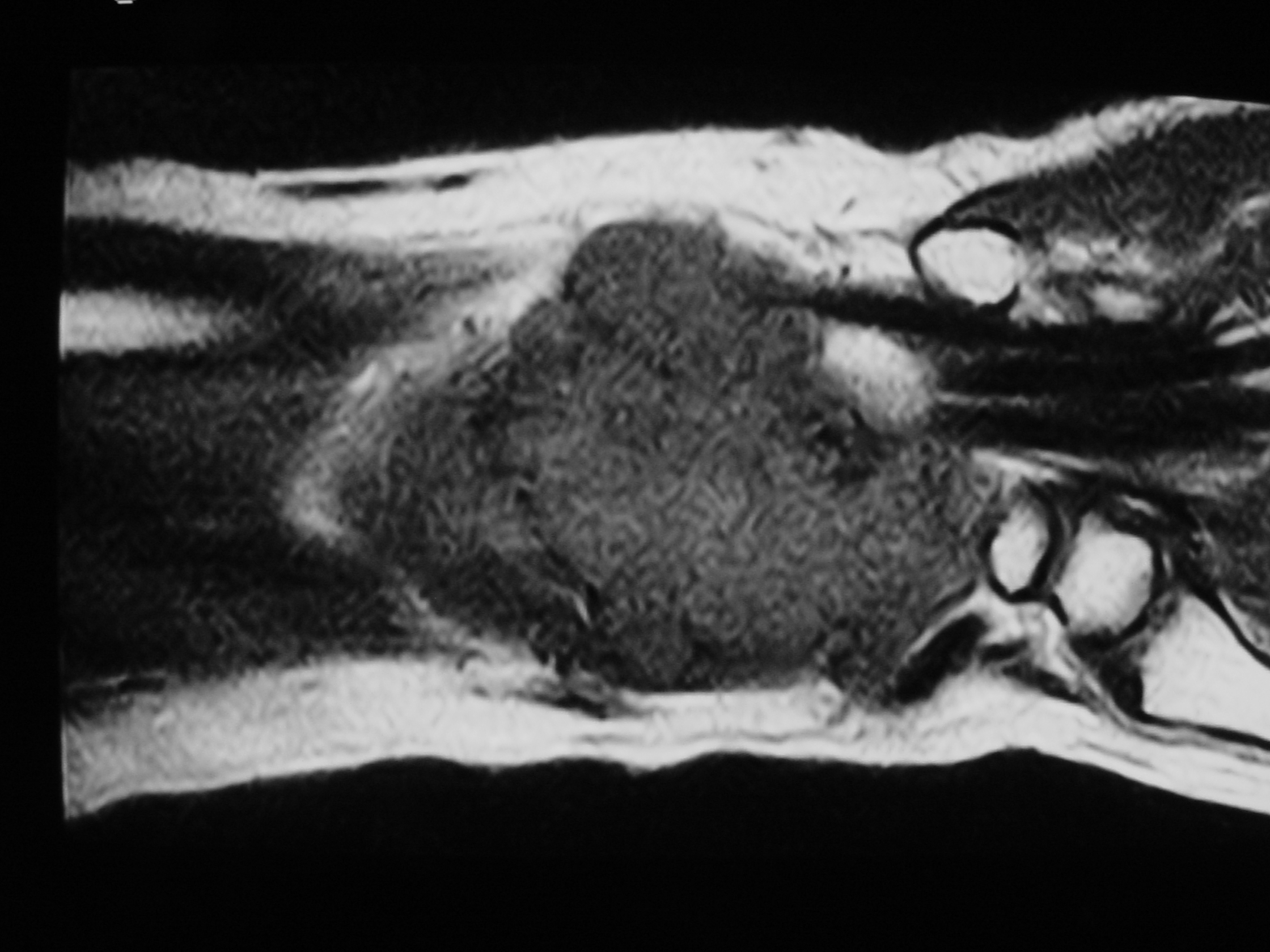 Fig. 5B MRI of Synovial Sarcoma of Wrist Area