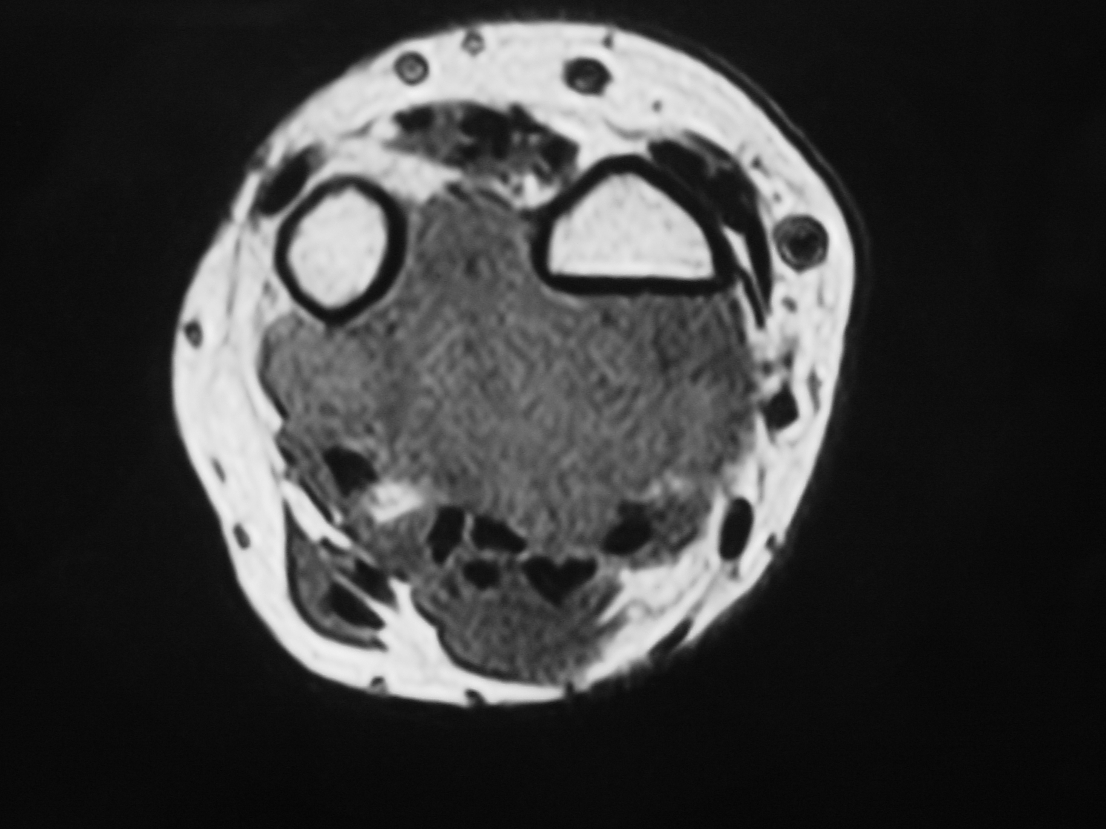 Fig. 5C MRI Axial T1 Synovial Sarcoma of Wrist Area