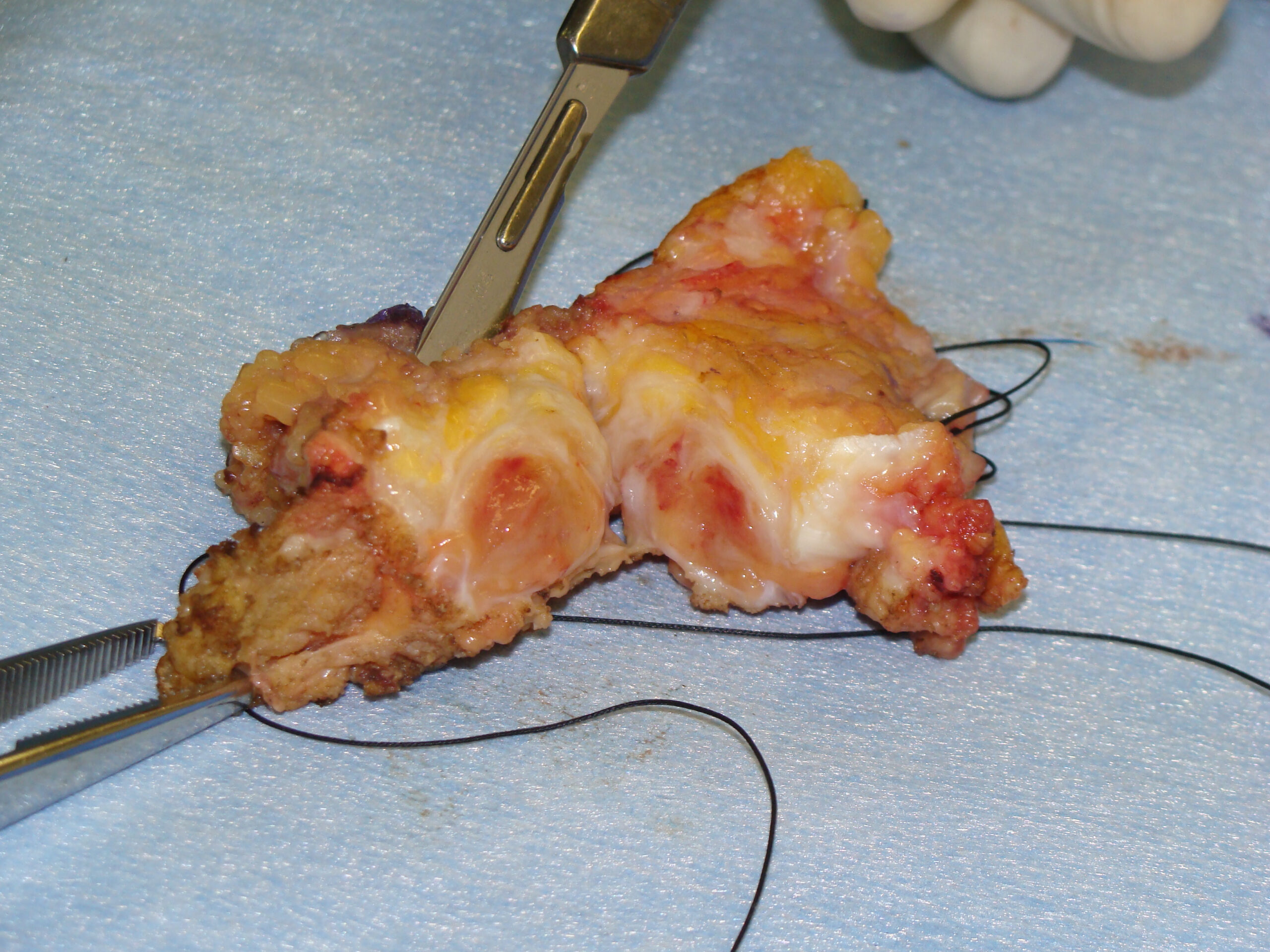 Fig. 6 Gross Specimen Synovial Sarcoma of Wrist Area