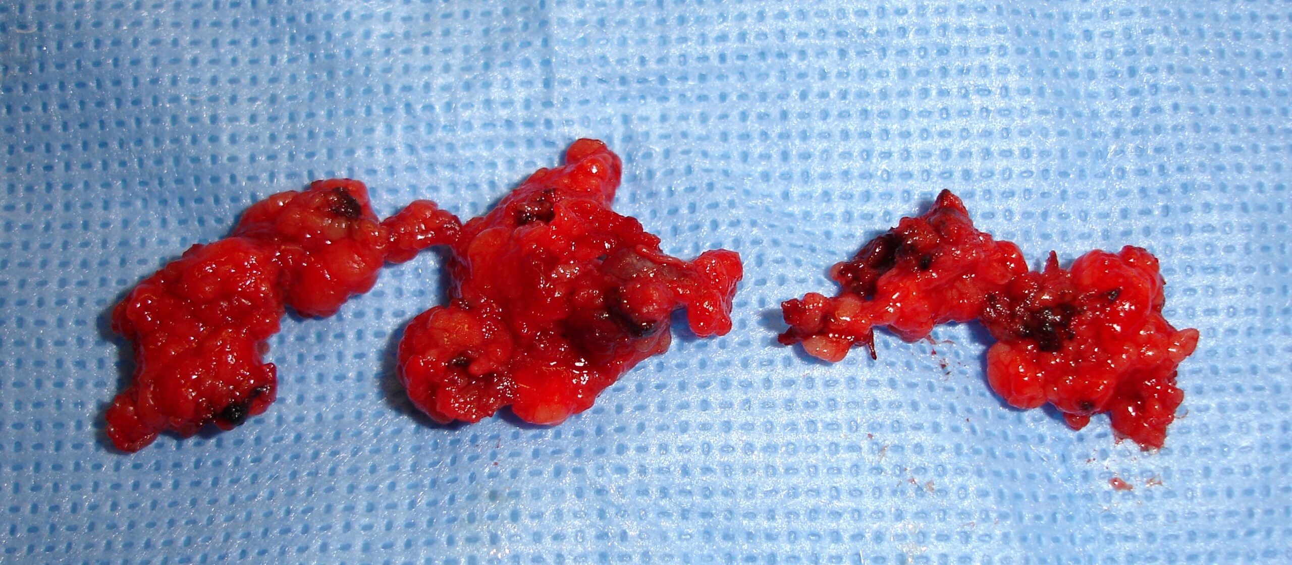 Fig. 6: Gross Pathology shows a lobulated and well circumscribed mass that is smaller than 5 cms. Fig. 6: Gross Pathology shows a lobulated and well circumscribed mass that is smaller than 5 cms.
