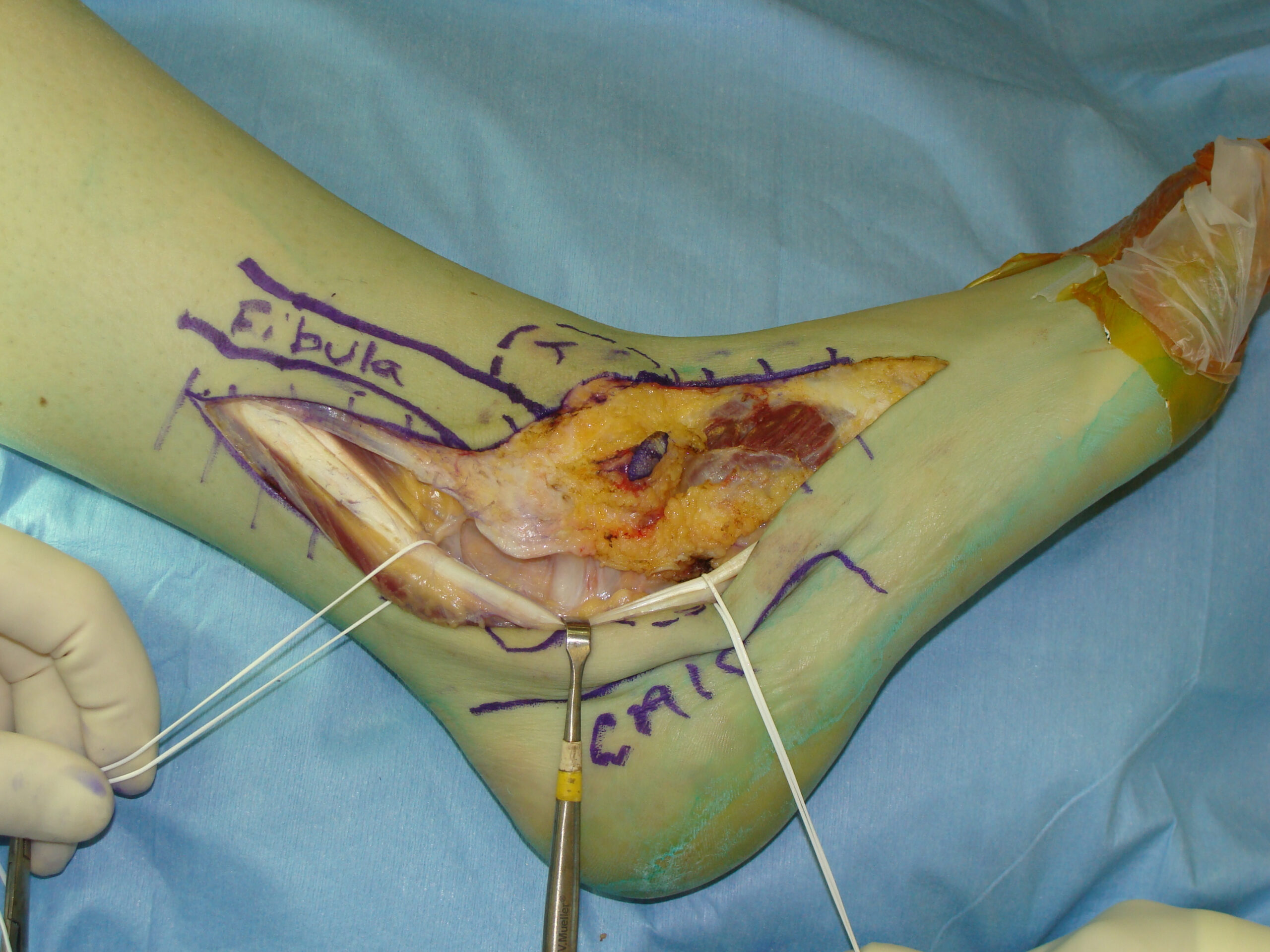 Fig. 8A Intraoperative Photo Synovial Sarcoma of Ankle