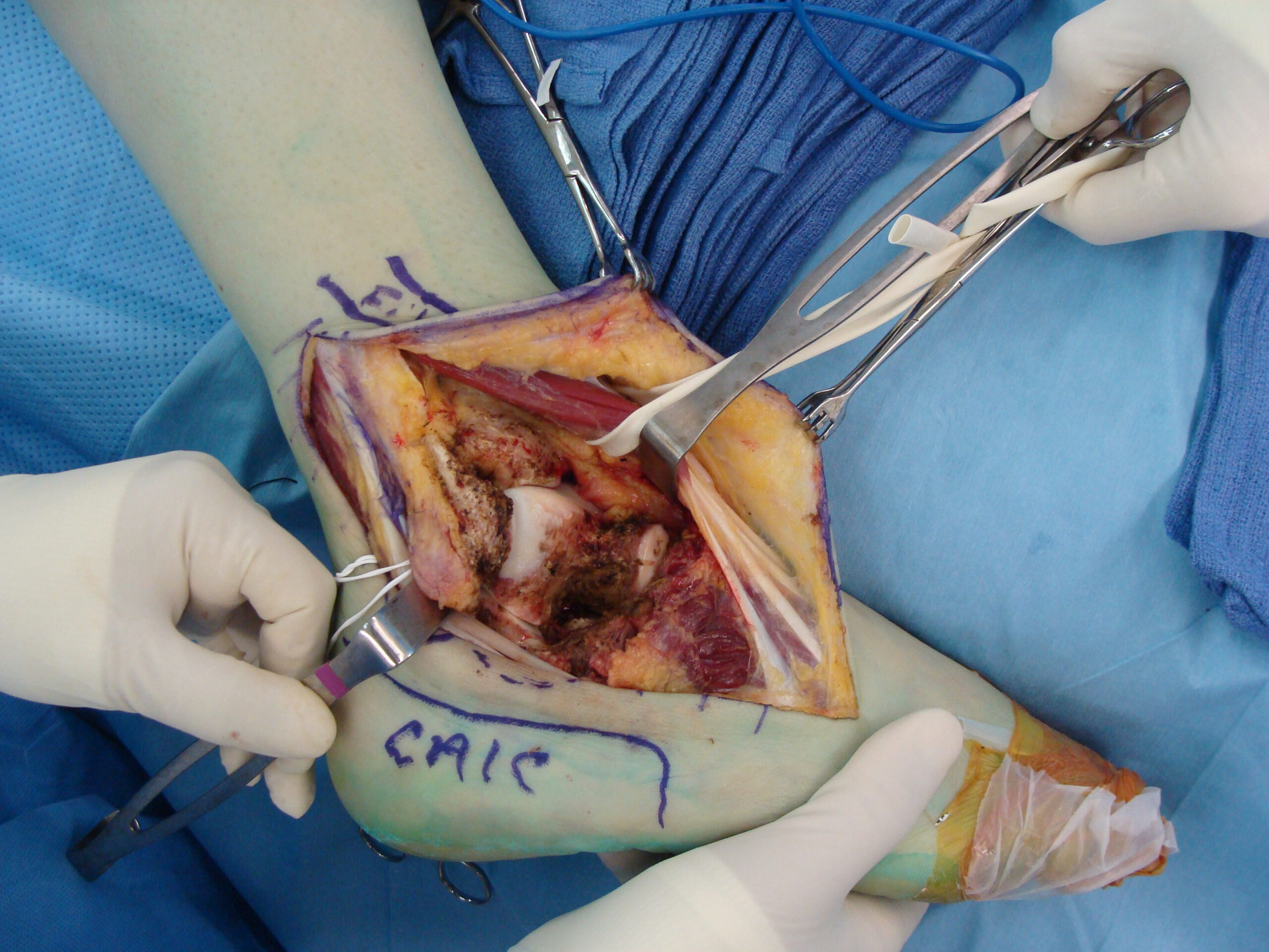 Fig. 8B Intraoperative Photograph after Resection of a Synovial Sarcoma from Ankle