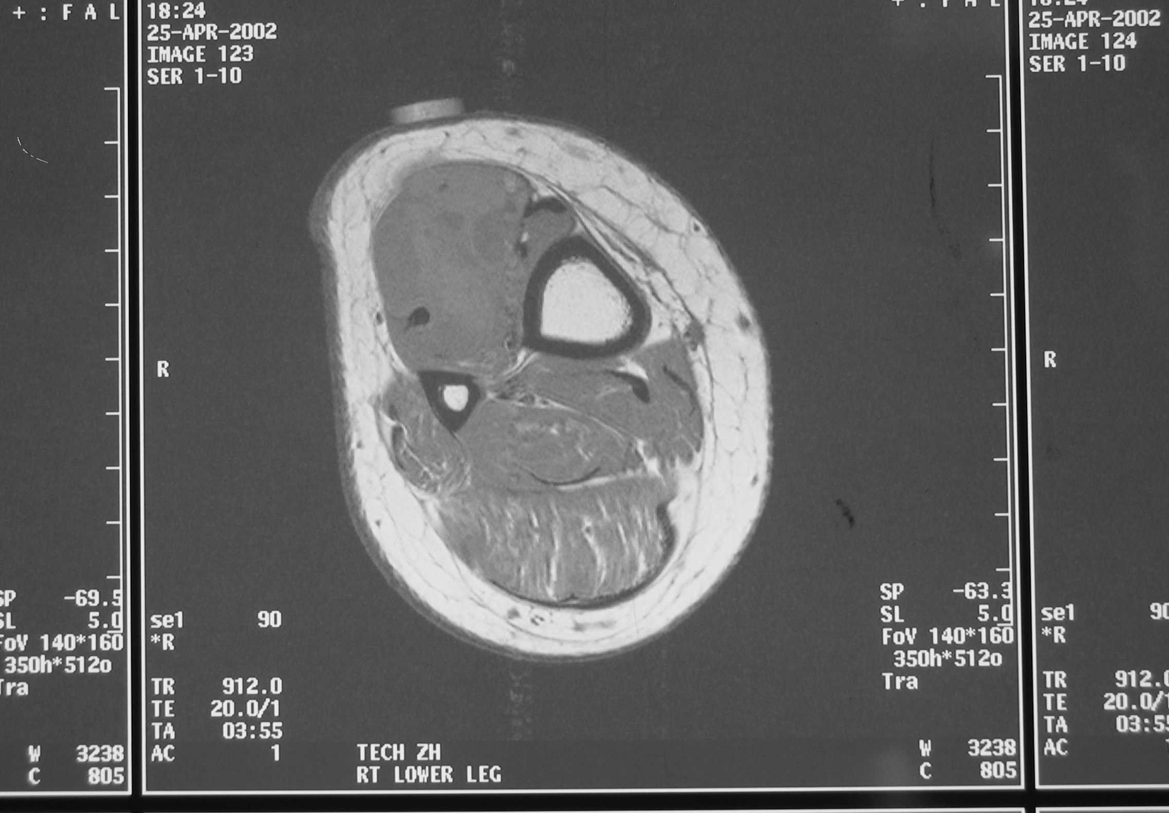 Fig. 2 MRI T1 Synovial Sarcoma of Leg