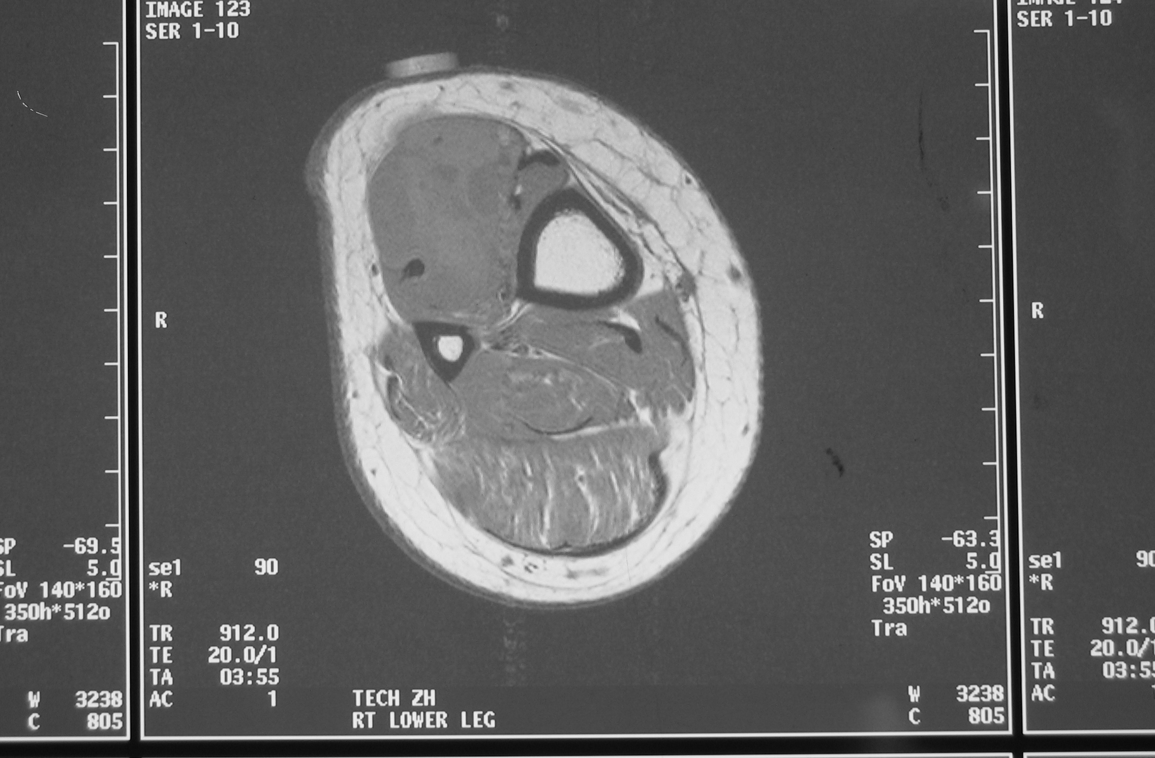 Fig. 2A MRI T1 Synovial Sarcoma of Leg