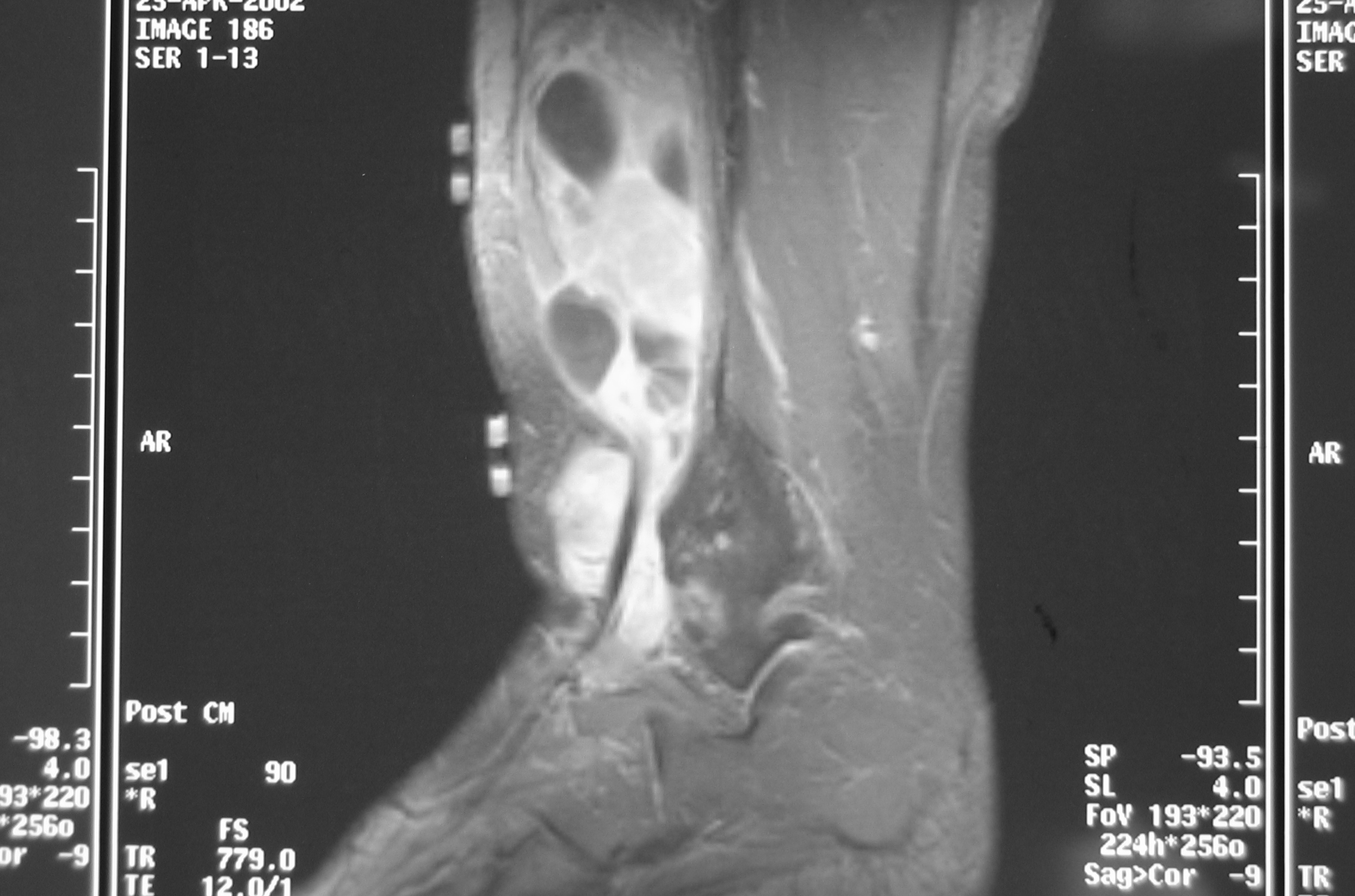 Fig. 2B MRI Sagittal T2 Synovial Sarcoma of Leg