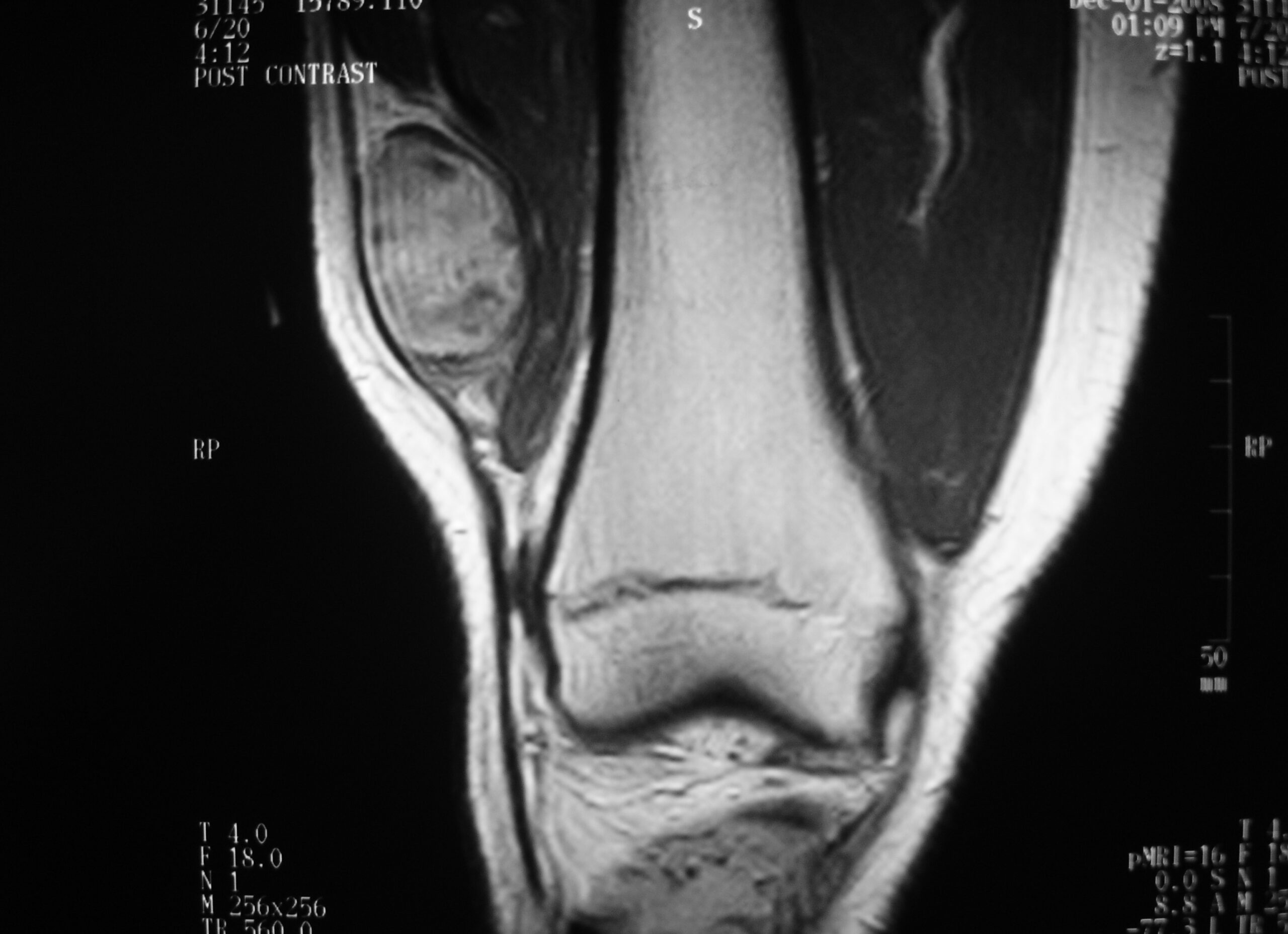 Fig. 3A MRI Coronal Synovial Sarcoma of Distal Thigh Knee Area