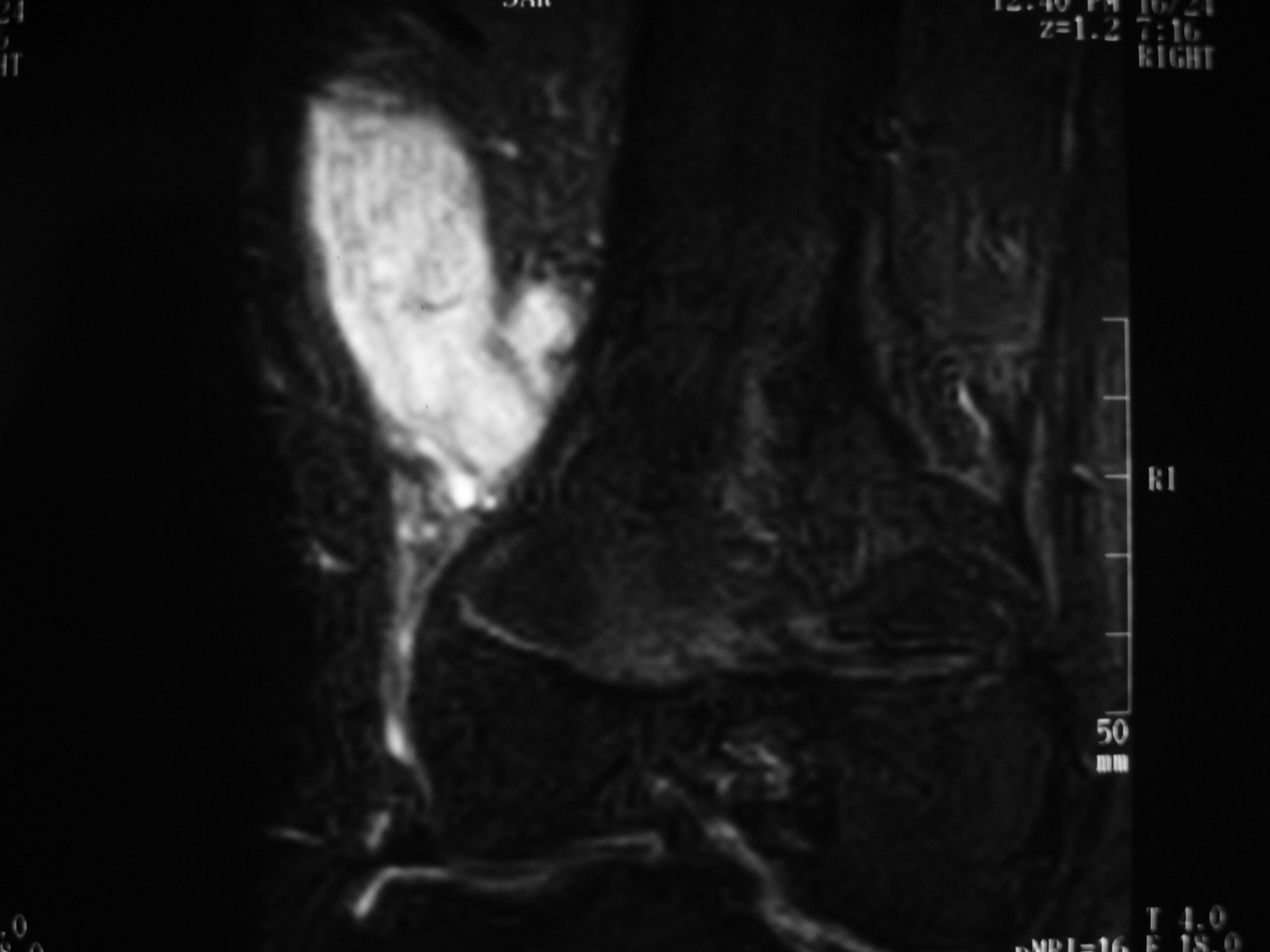 Fig. 3B MRI T2 Synovial Sarcoma of Distal Thigh