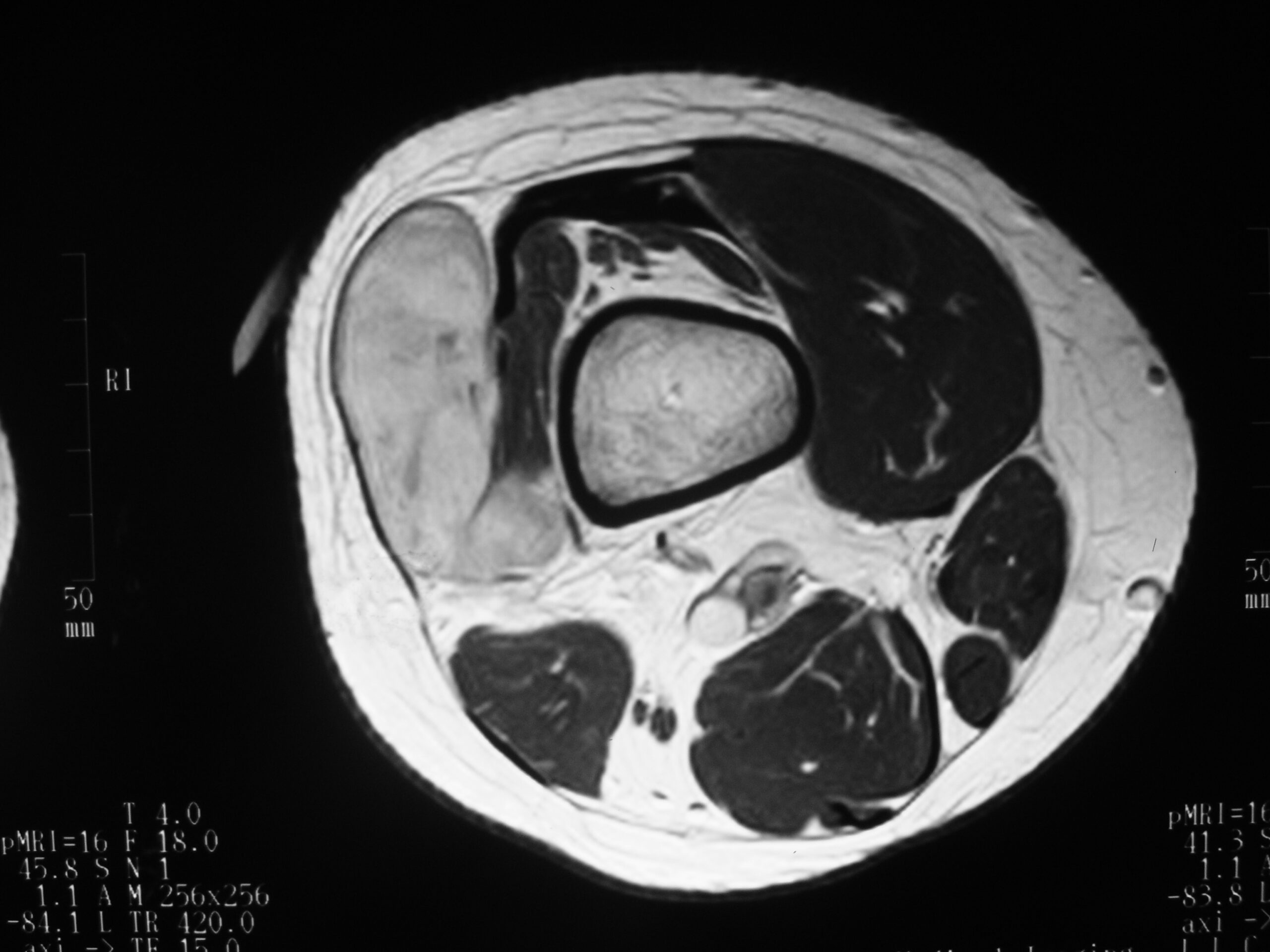Fig. 3C MRI Axial Synovial Sarcoma of Distal Thigh