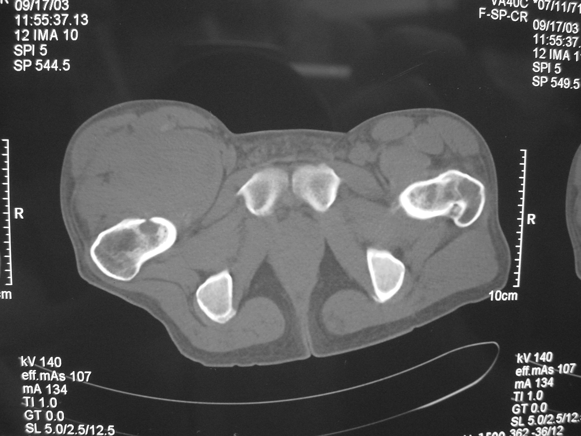 CT Scan Synovial Sarcoma of Thigh Invading Proximal Femur