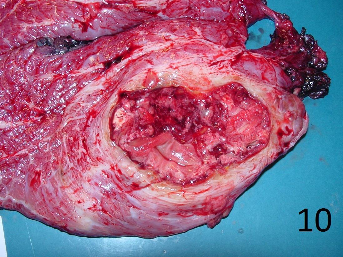 Fig. 10: Photograph of gross specimen of fibrosarcoma of buttock after radical resection