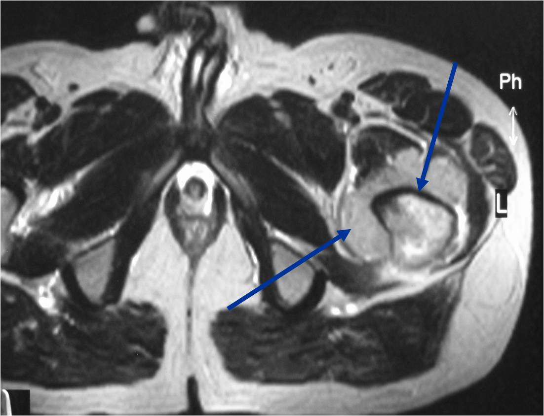 Radiographic Presentation: Primary Lymphoma of Bone, Cortex Appears Inteact (top) Soft Tissue Mass (bottom) T2 Weighted MRI Radiographic Presentation: Primary Lymphoma of Bone, Cortex Appears Inteact (top) Soft Tissue Mass (bottom) T2 Weighted MRI