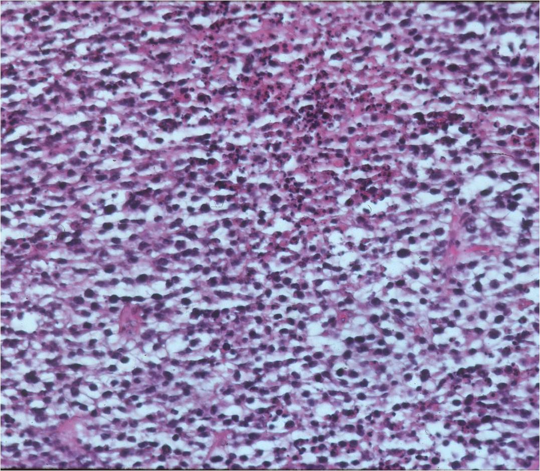 Microscopic Pathology: Lymphoma Microscopic Pathology: Lymphoma