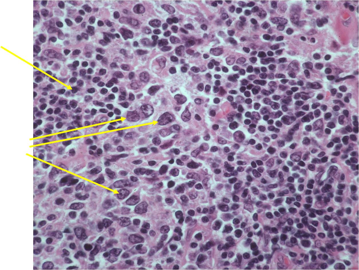 Microscopic Pathology: Lymphoma, Reactive Inflammatory, Infiltrate of Plasma Cells and Lymphocytes, Large Malignant B-cells Microscopic Pathology: Lymphoma, Reactive Inflammatory, Infiltrate of Plasma Cells and Lymphocytes, Large Malignant B-cells