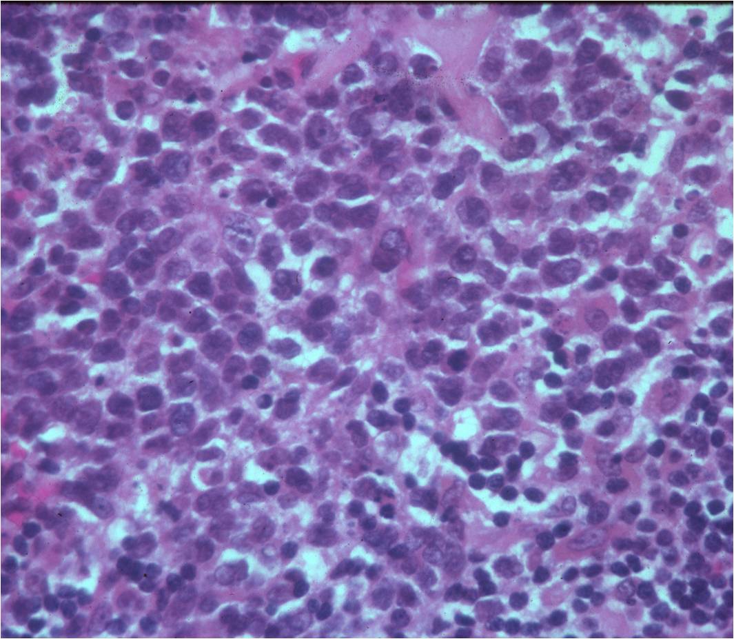 Microscopic Pathology: Lymphoma Microscopic Pathology: Lymphoma