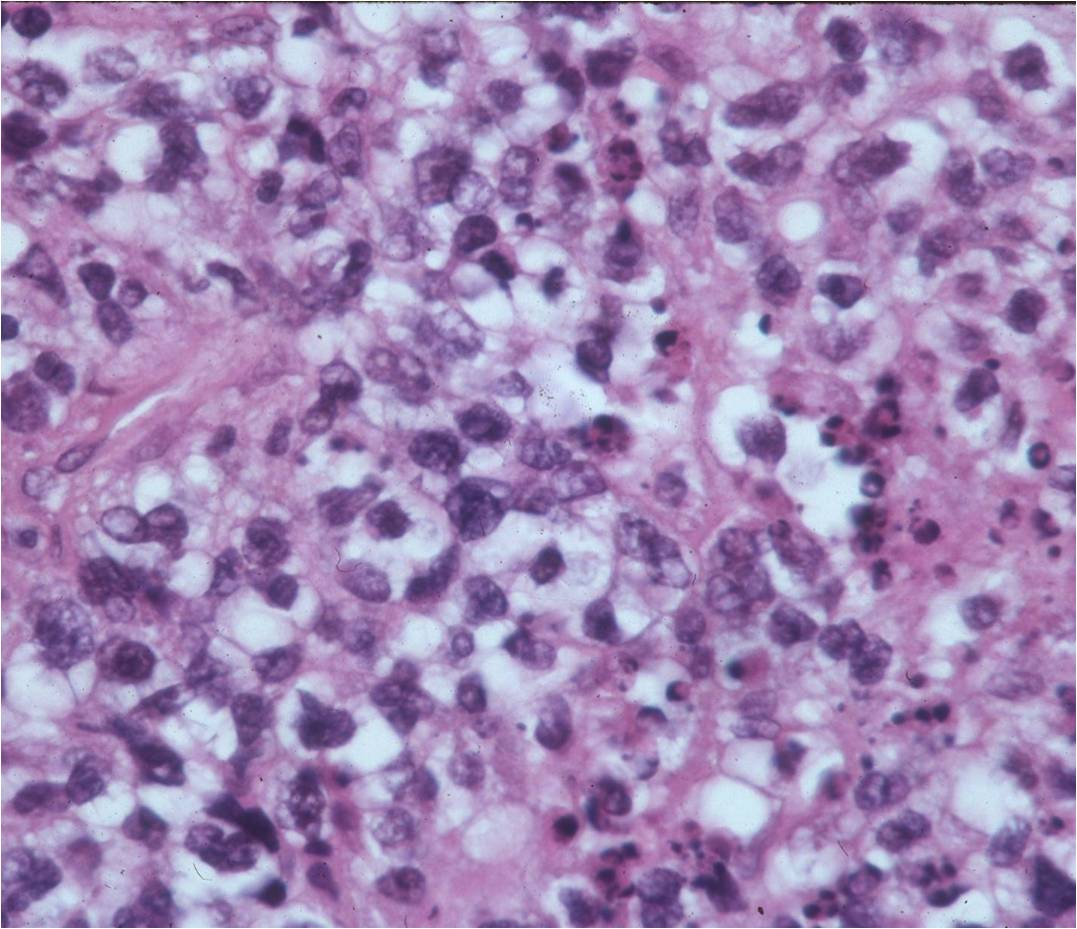 Microscopic Pathology: Lymphoma Microscopic Pathology: Lymphoma