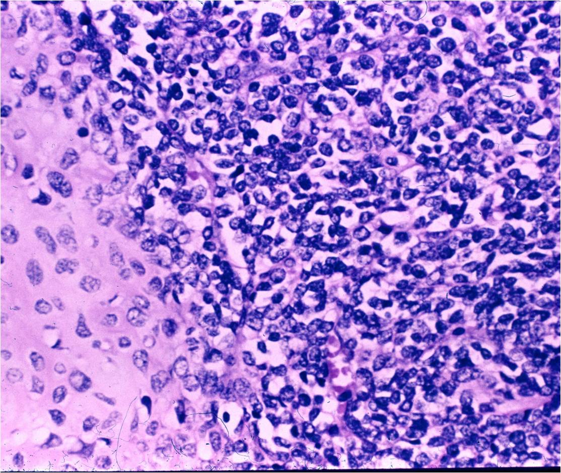 Mesenchymal Chondrosarcoma, microscopic pathology